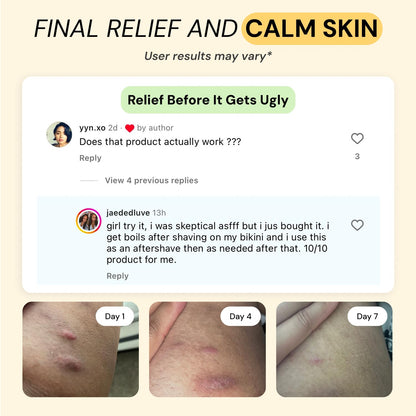 Universal Flare Care | Relief for 97% of Skin Issues | Cysts, Inflamed Skin, Hidradenitis Suppurativa, Abscesses, Impetigo | All Natural Flare Up Solution With Propolis & Egg Yolk Extract 4 oz