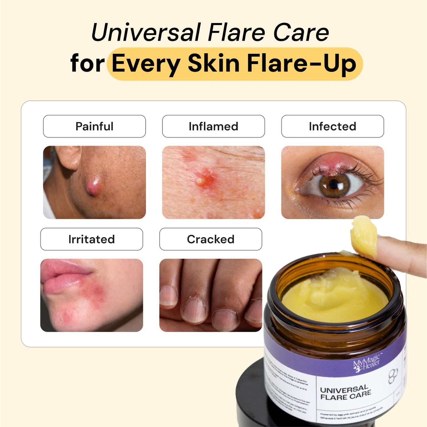 Universal Flare Care | Relief for 97% of Skin Issues | Cysts, Inflamed Skin, Hidradenitis Suppurativa, Abscesses, Impetigo | All Natural Flare Up Solution With Propolis & Egg Yolk Extract 4 oz